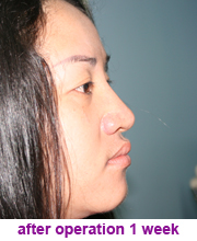 plastic_surgery_augmentation_rhinoplasty